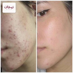 فوم شستشو براش دار روغن درخت چای نو آکنه NO ACNE - نمای 2